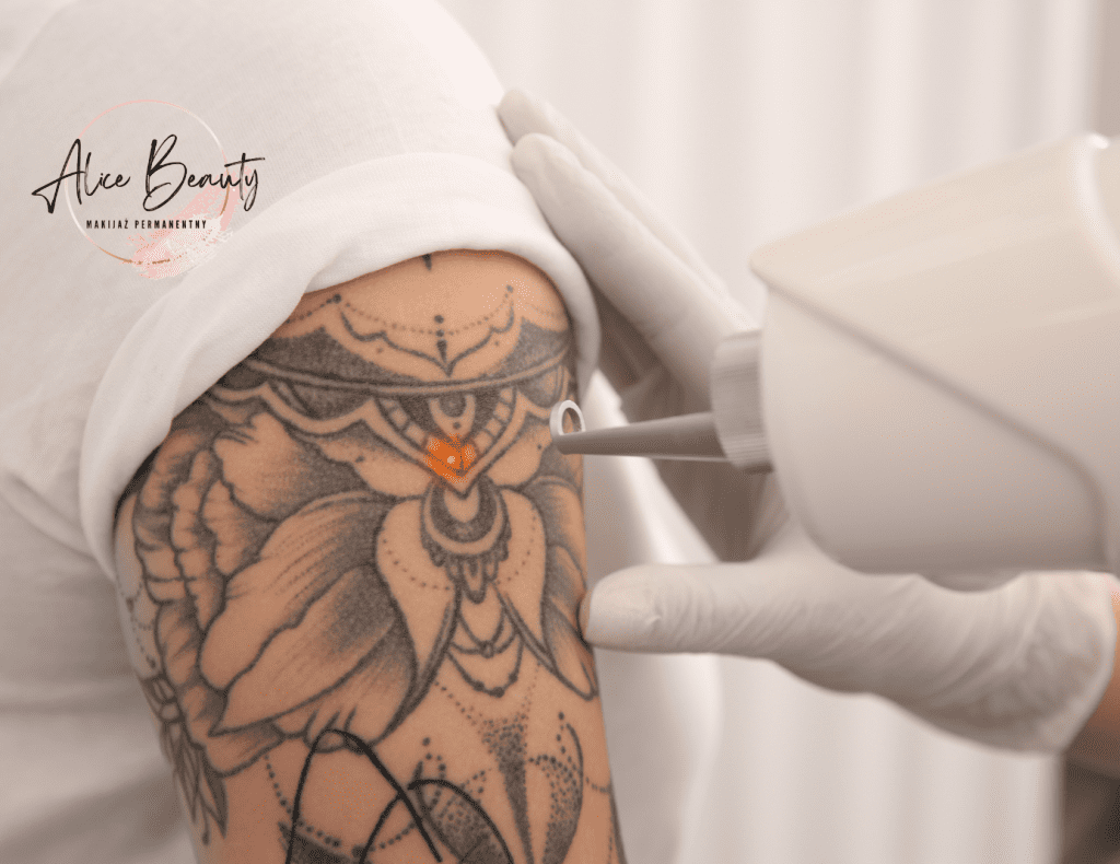 usuwanie tatuażu świdnica