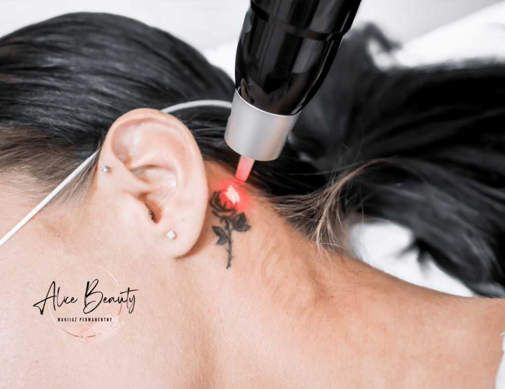 usuwanie tatuażu świdnica