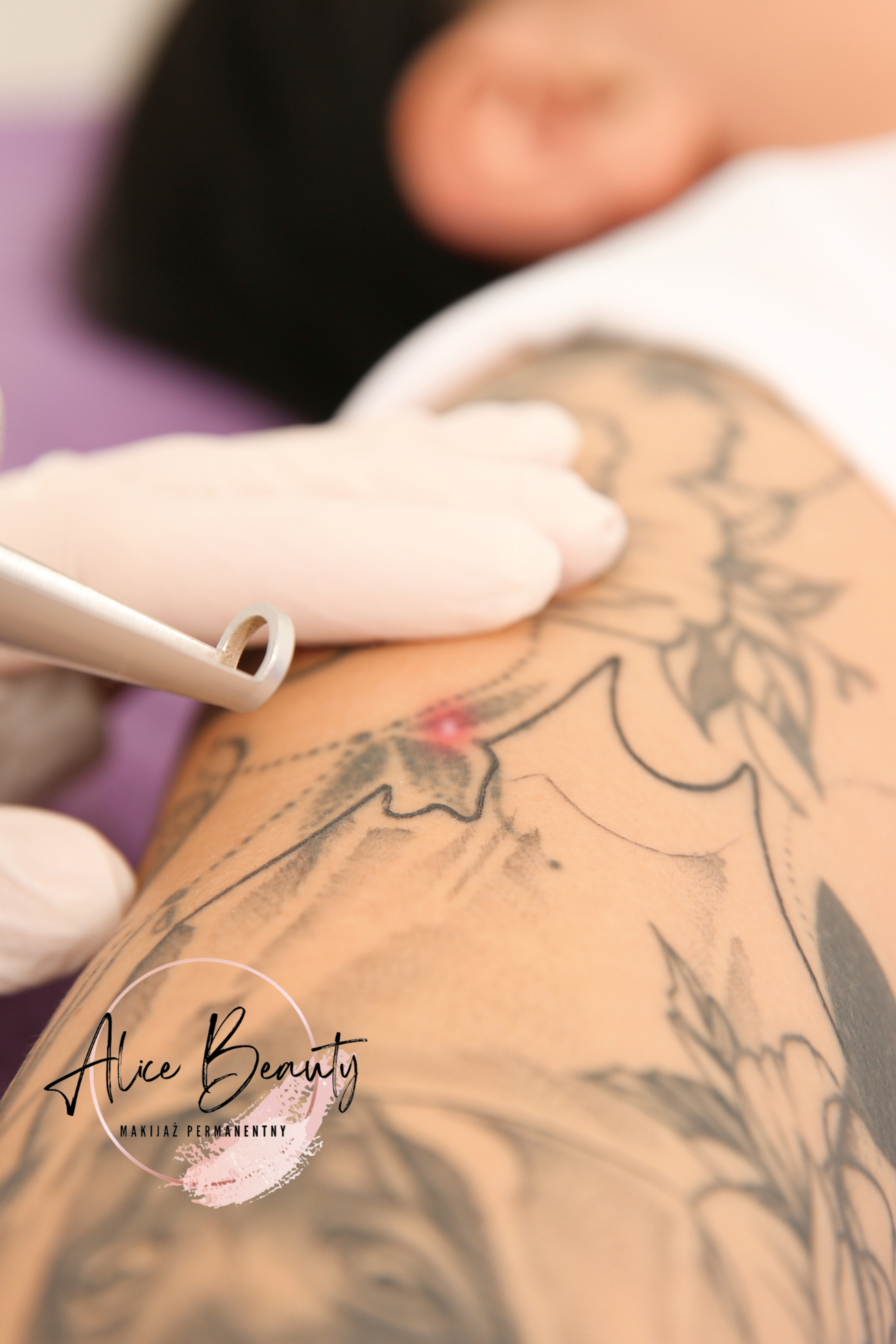 usuwanie tatuażu świdnica