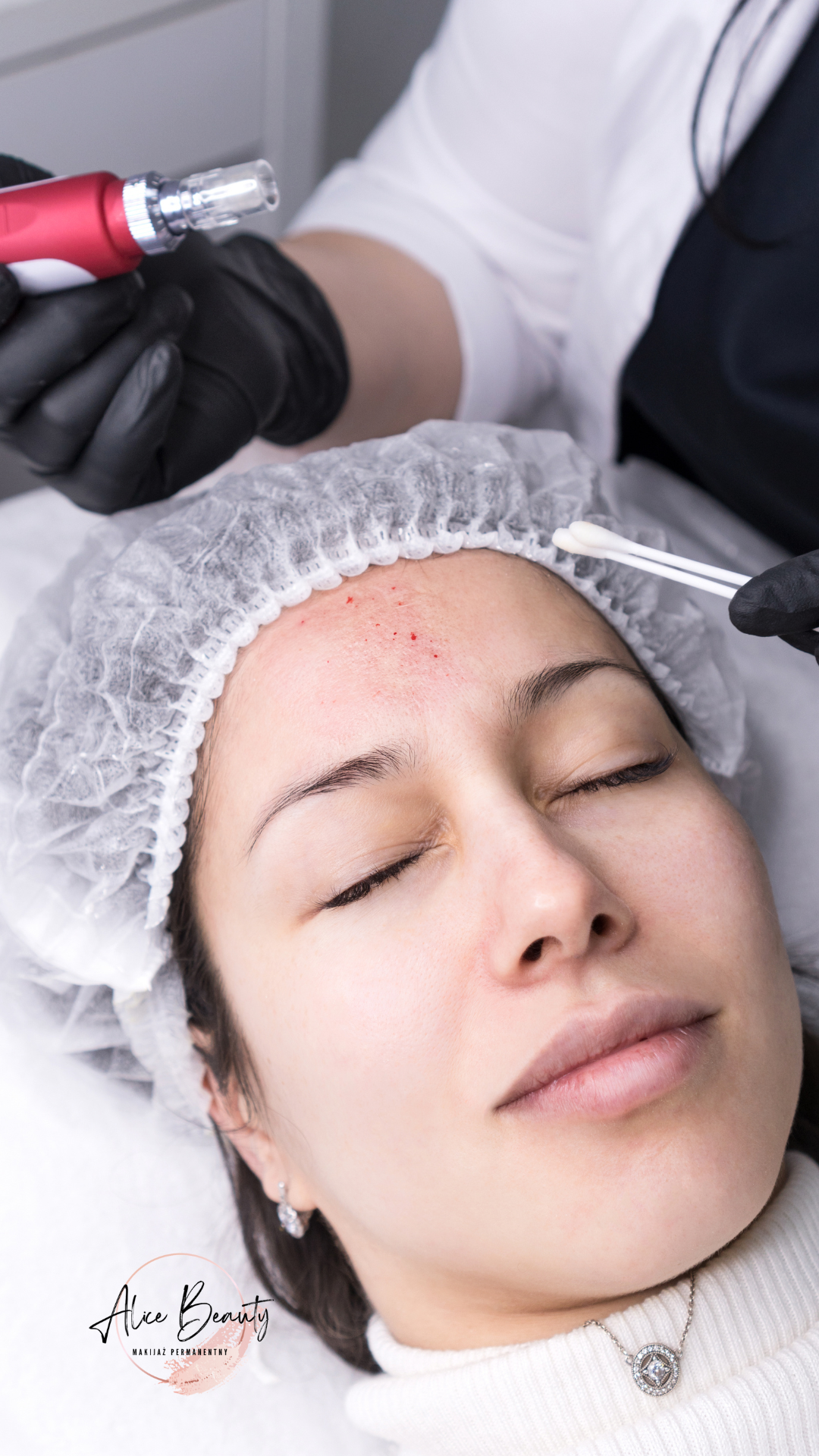 mezoterapia mikroigłowa Świdnica